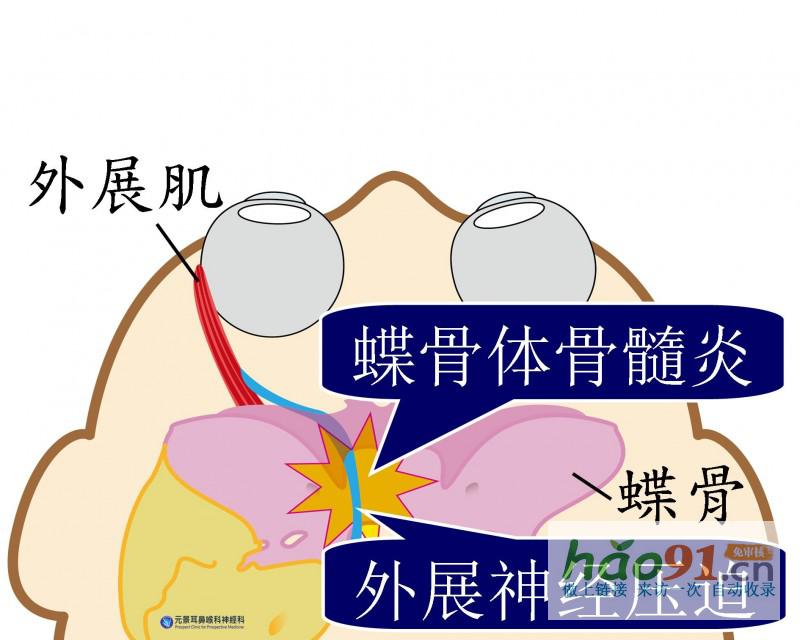 一侧眼球无法转动七旬老人患罕见蝶骨体感染